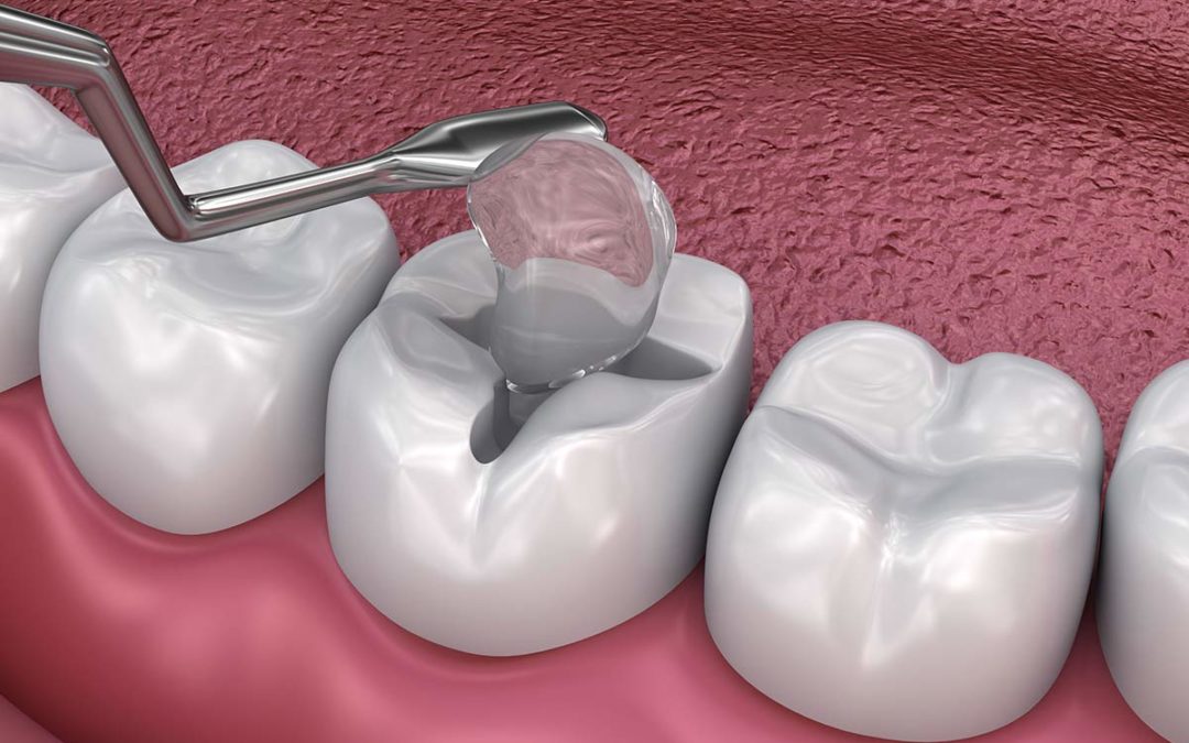 Tooth Fillings in Pune