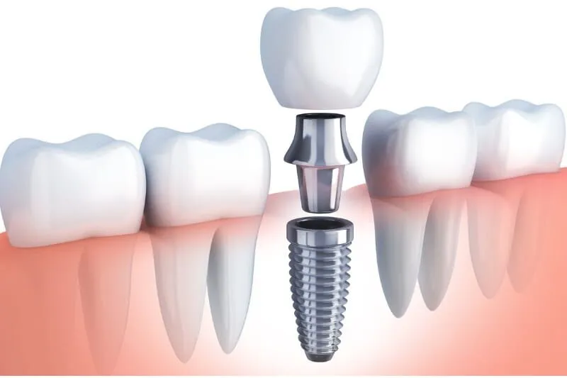 Dental implants in Pune